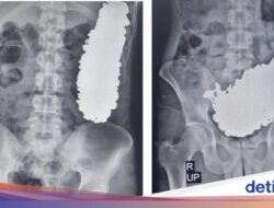 Aneh Tapi Nyata! Pria Ke Iran Telan 452 Benda Logam, Baut hingga Mur